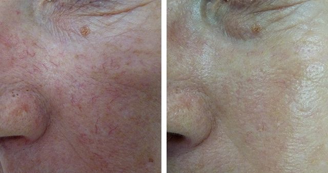 capillary-rosacea-2-1