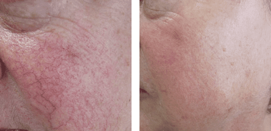 rosacea