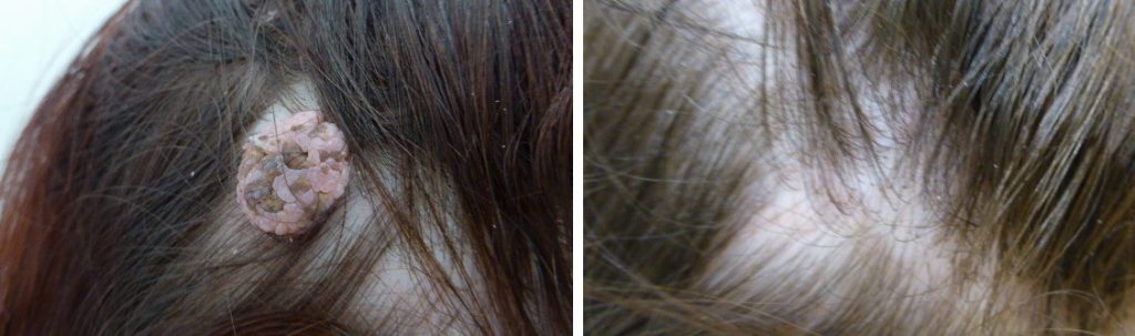 Mole Removal Before & After 2