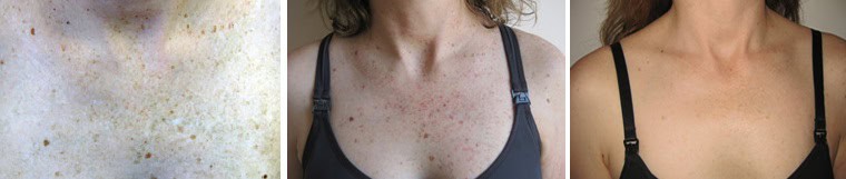 IPL Treatment Before & After