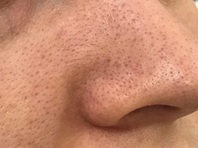 LARGE-PORES-1024x933 (1)