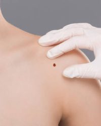 Dermatologist examining birthmark on woman shoulder, closeup. Cancer prevention concept, empty space